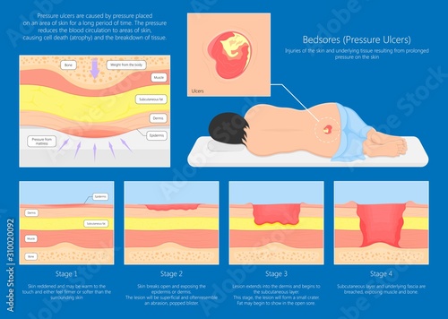 Bedsores (pressure ulcers) injuries skin underlying tissue from lying down or sitting prolonged period time with paralysis patient and immobility adults