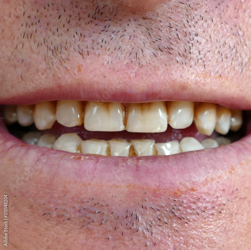  neglected mouth and yellowed teeth of a person,
