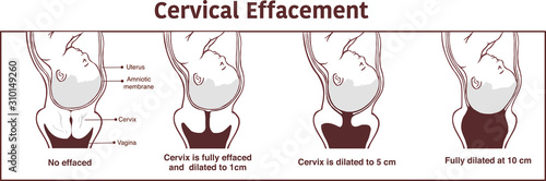 Vector - Cervical effacement and dilatation during labor