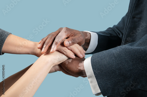 Close up of male hands with vitiligo pigments isolated on blue studio background. Wearing office attire  workwear. Special skin. Careful holding hands. Business  finance  ad concept. Copyspace.