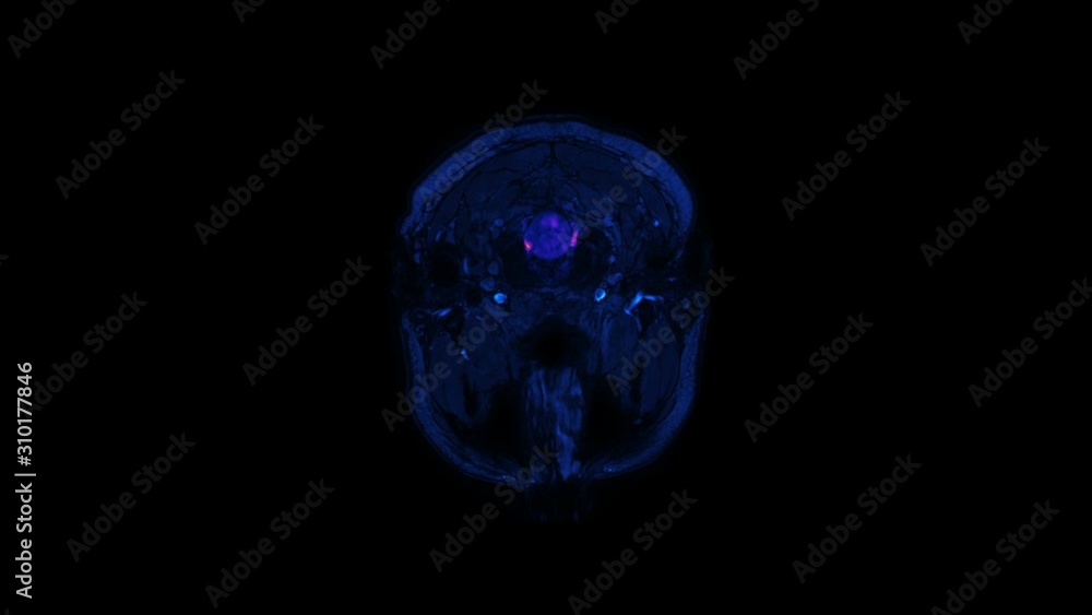 Magnetic Resonance Imaging MRI scan of a Human brain dysfunction, problem areas. Time lapse. X-ray, Computed medical tomography. RGB infrared camera Magnetic Resonance Imaging MRI scan of a Human brain dysfunction, problem areas. Time lapse. X-ray, Computed medical tomography. RGB infrared camera