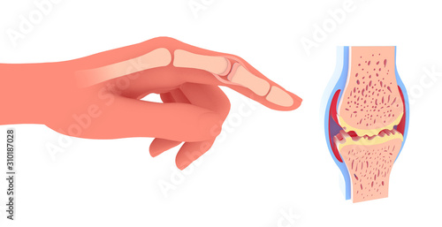 3d illustration of synovial joint with osteoarthritis. Next to the graphic representation of a hand placing the joint. photo