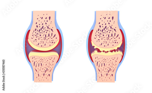 3d illustration of healthy synovial joint and with osteoarthritis. Images isolated on white background front view. Vivid colors. photo