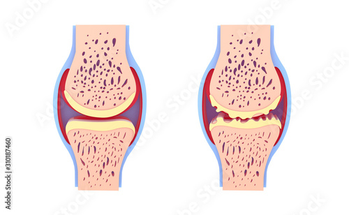 3d illustration of healthy synovial joint and with osteoarthritis. Images isolated on white background front view. Vivid colors.