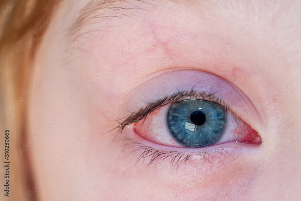 Obraz premium Closeup of irritated red bloodshot eye - conjunctivitis