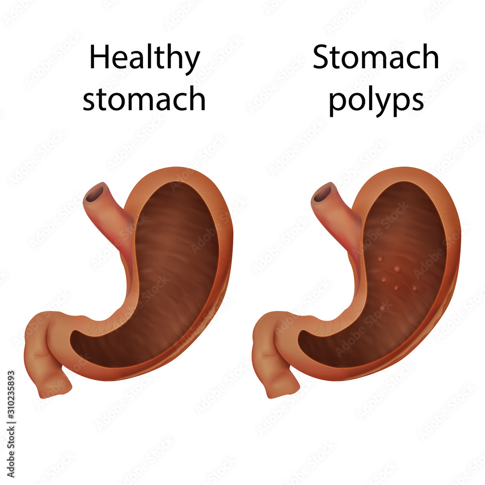 stomach-polyps-and-healthy-organ-abnormal-growth-of-tissue-medical