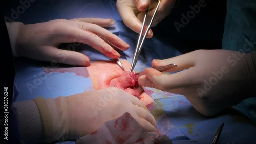 circumcision surgery operation of a boy in hospital surgeon room photo