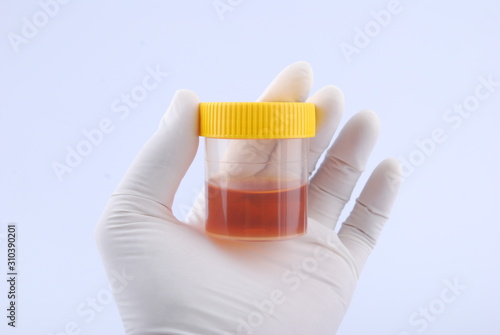 Hand hold bottles of urine test sample