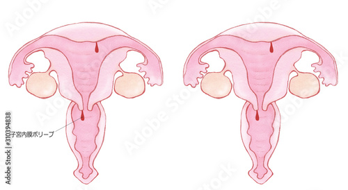 子宮頸管（内膜）ポリープ photo