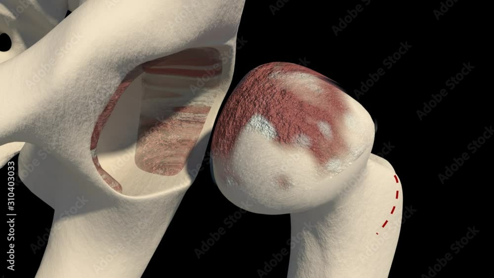 Total Hip Replacement