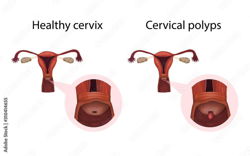 Cervix polyps and healthy organ. Cervical disease. Abnormal growth of tissue.  Medical anatomy illustration. Illustration Stock | Adobe Stock