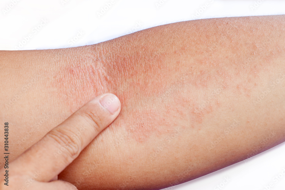 Close up of an women's inner forearm arm infested with Rash. Close up of an women's inner forearm arm infested with Rash.
