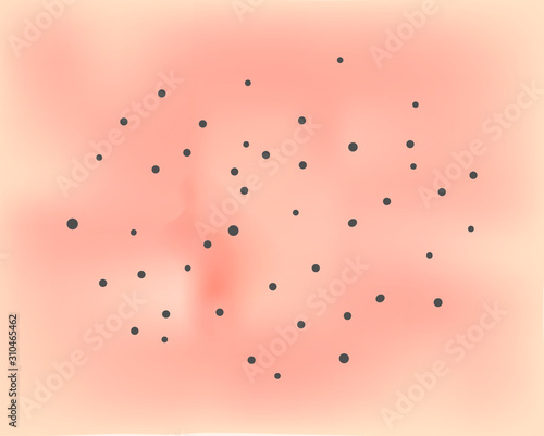 Open comedos. Skin with acne background. Black spots. Acne on the skin texture. Infographics. Vector illustration.