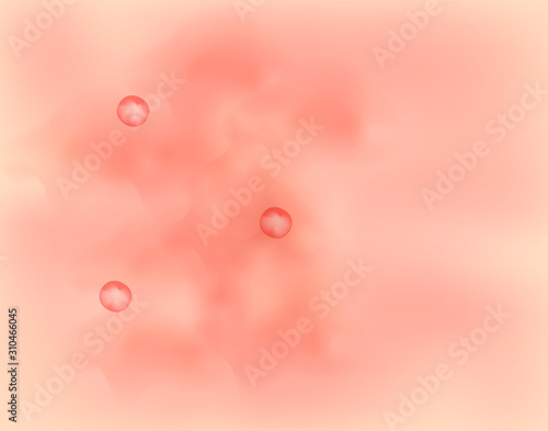 Papules on the skin. Acne. Pimples on the skin background. Acne on the skin texture. Infographics. Vector illustration.