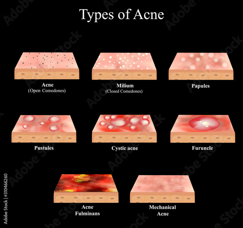 Types of Acne Skin inflammation. Pimples, boils, whitehead, closed comedones, papules, pustules, cystic acne. Infographics. Vector illustration on a black background.