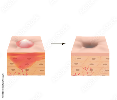 Inflamed acne on the skin. Inflamed pimple. The structure of the skin. Acne scar. Infographics. Vector illustration on isolated background.