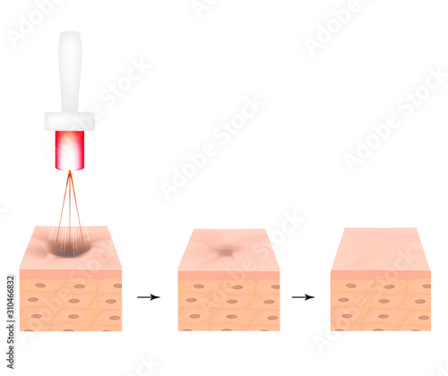 Acne scars. Laser scar atrophic treatment. The anatomical structure of the skin with acne. Vector illustration on isolated background.