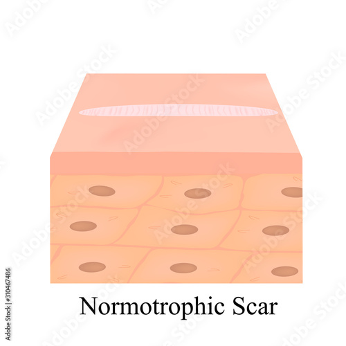 Scars normotrophic. The anatomical structure of the skin scar. Vector illustration on isolated background.