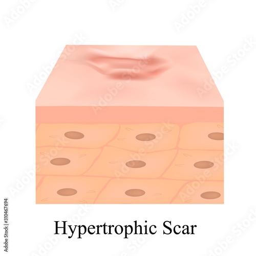 Scars hypertrophic. The anatomical structure of the skin scar. Vector illustration on isolated background.