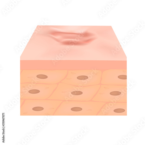 Scars hypertrophic. The anatomical structure of the skin scar. Vector illustration on isolated background.