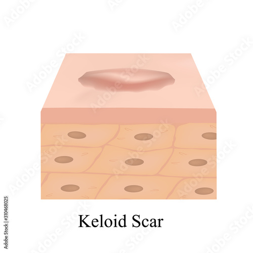 Scars Keloid. The anatomical structure of the skin scar. Vector illustration on isolated background.