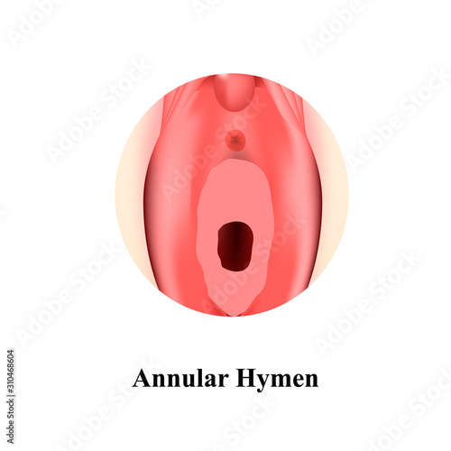 The structure of the vulva hymen annular. Hymen after defloration. Female genital organs. Infographics. Vector illustration on isolated background.