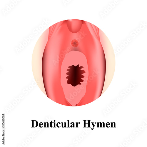 The structure of the vulva hymen Denticular. Hymen after defloration. Female genital organs. Infographics. Vector illustration on isolated background.