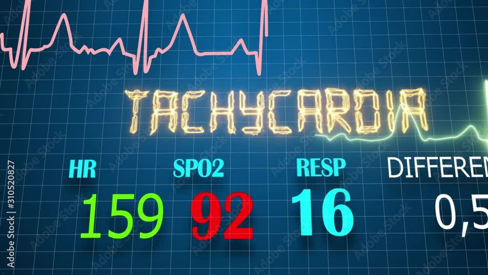 Screen of the ECG device. cardio disease. test result..ECG Pathology Trace Screen of the ECG device. cardio disease. test result..ECG Pathology Trace