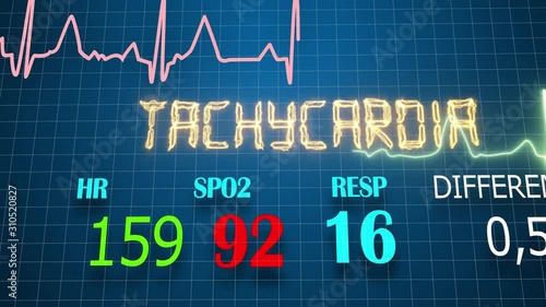 Screen of the ECG device. cardio disease. test result..ECG Pathology Trace