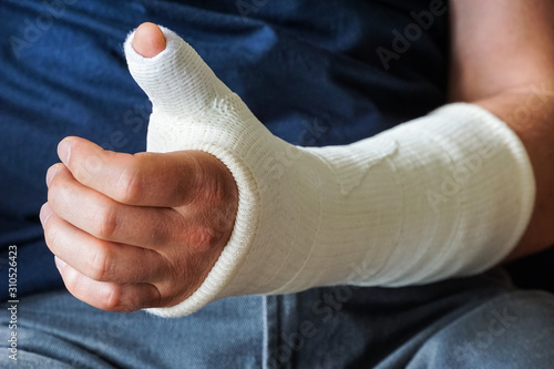 Man with plaster cast on broken hand, broken thumb,broken wrist