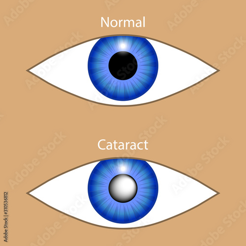 Eye with cataract and normal. Vector illustration of healthy and illness optic organ. Blurred vision in glaucoma. Diagnosis and treatment of ophthalmic diseases. Concept for medical brochure, banner.
