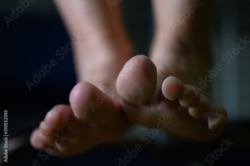 Close up of woman feet having tinea pedis althlete's fungus infection