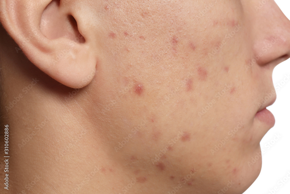 Teen guy with acne problem on white background, closeup Teen guy with acne problem on white background, closeup