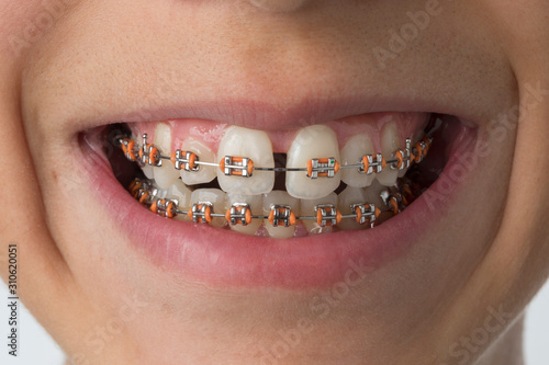 Close up of a mouth with dental braces photo