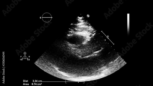 Image of the heart in gray-scale mode during transesophageal ultrasound. © faustasyan