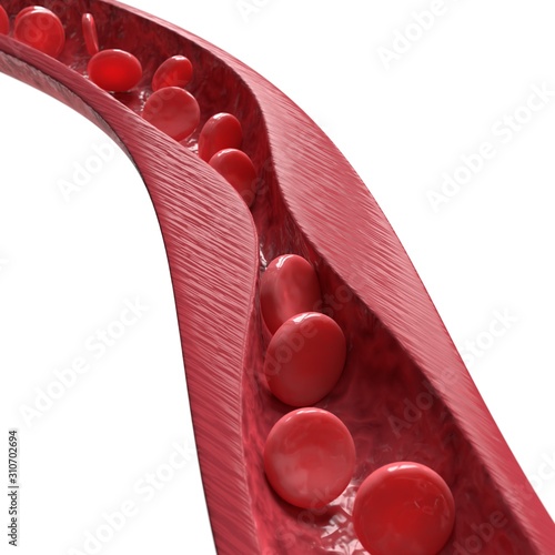 Atherosclerosis closeup. 3d illustration isolated on white