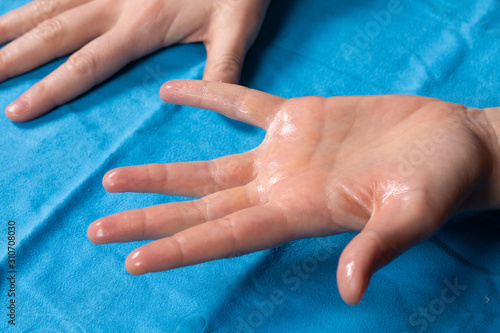 signs, symptoms and manifestations of hyperidrosis: concept of adherence to therapy