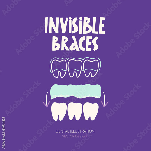 Orthodontic silicone trainer. Invisible braces aligner. Mobile orthodontic appliance for dental correction. Hand- drawn illustration.