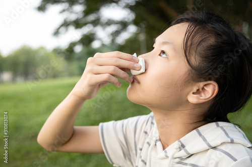 Sick asian child girl using tissue paper for stop bleeding from the nose,female teenage with nosebleed or epistaxis suffer from allergic rhinitis,respiratory or nose injury, bleeding from an accident photo