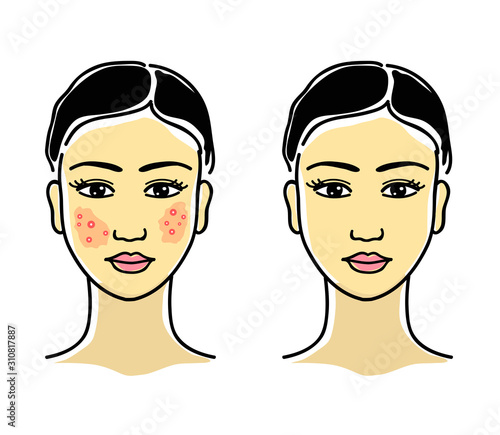 Acne on the face of a young girl. Vector illustration. 