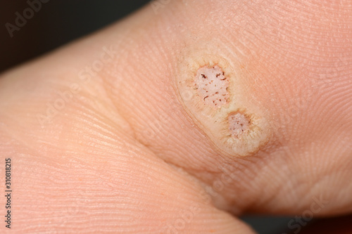 Closeup of two plantar warts on a toe caused by the human papillomavirus, or HPV