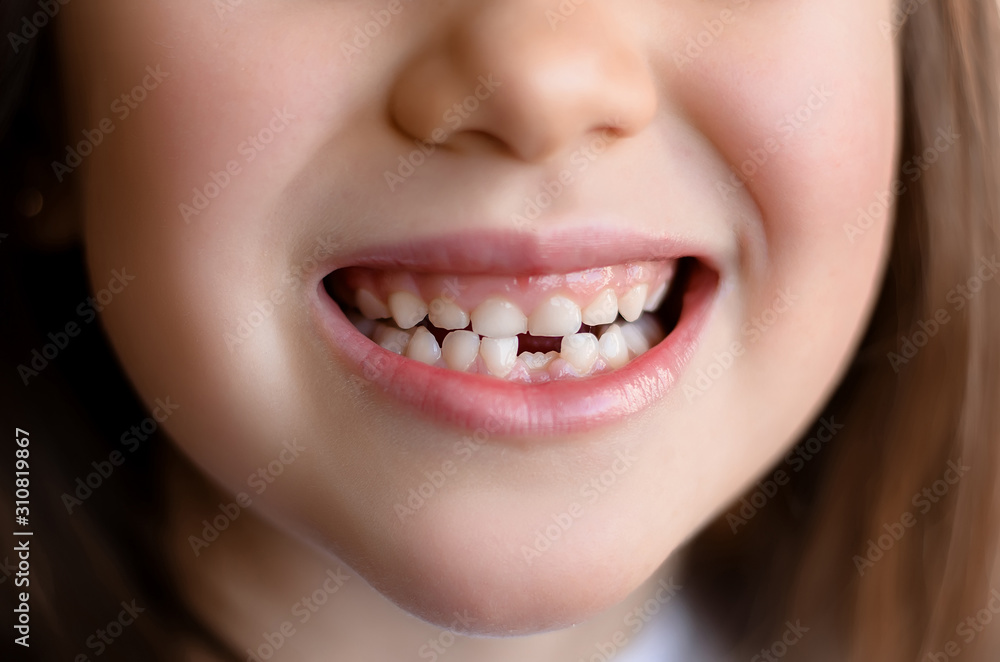 Beautiful smiling preschool girl with her first adult incisor tooth. Cute child showing her baby milk tooth fell out and her growing permanent tooth in open mouth. Dental hygiene concept Beautiful smiling preschool girl with her first adult incisor tooth. Cute child showing her baby milk tooth fell out and her growing permanent tooth in open mouth. Dental hygiene concept