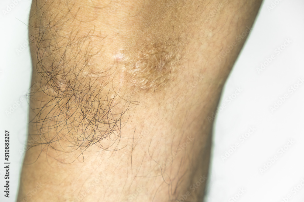 Scar on the knee with the hairs Scar on the knee with the hairs