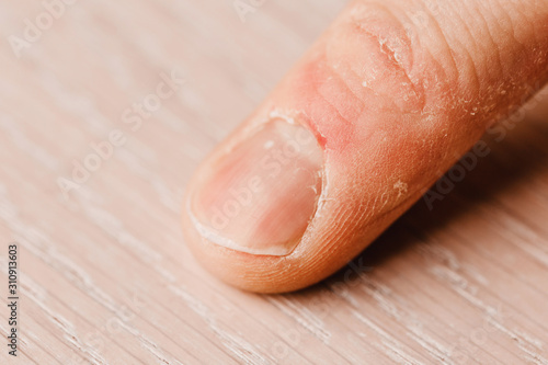 Finger condition before manicure - crooked dirty nails