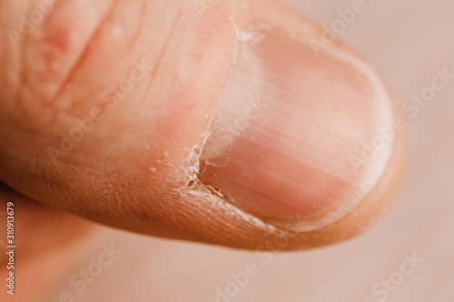 Close-up thumb with dry skin - Dermatology