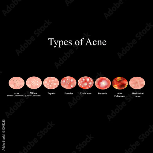 Types of Acne Skin inflammation. Pimples, boils, whitehead, closed comedones, papules, pustules, cystic acne. Infographics. Vector illustration on a black background.