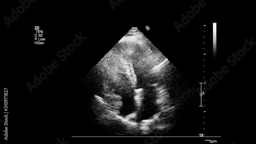 Image of the heart in gray-scale mode during transesophageal ultrasound.