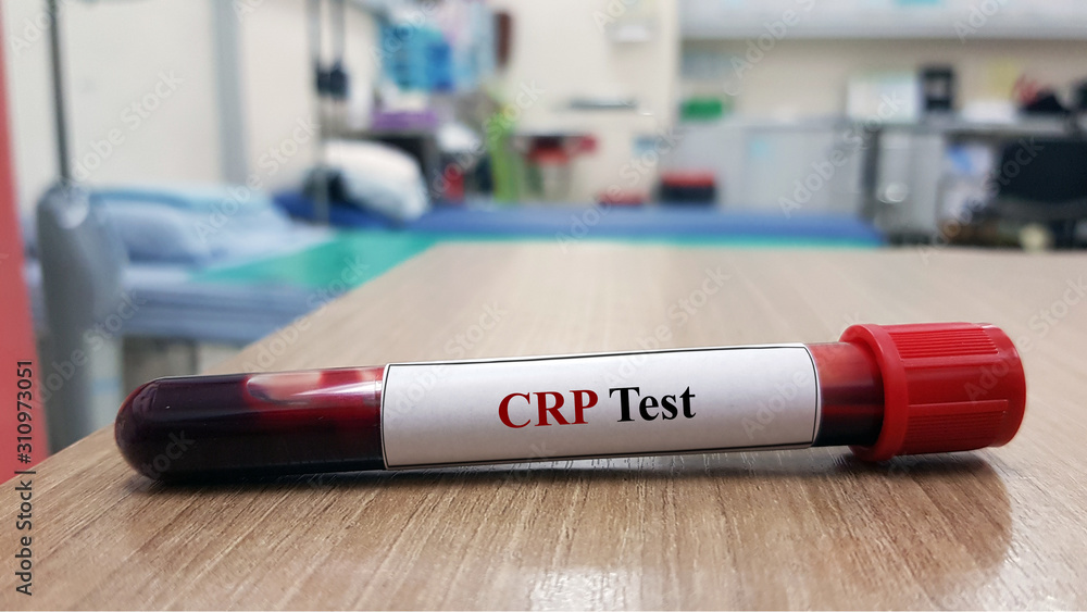Laboratory sample of blood testing for creactive protein(CRP test) It