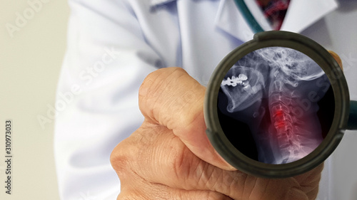Bild auf Leinwand Orthopedist doctor check film X-ray of cervical spine spondylosis which is spinal disc degenerative disease