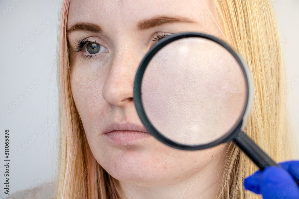 Enlarged pores, black spots, acne, rosacea close-up on the cheek. A woman is being examined by a doctor. Dermatologist examines the skin through a magnifier, a magnifying glass Enlarged pores, black spots, acne, rosacea close-up on the cheek. A woman is being examined by a doctor. Dermatologist examines the skin through a magnifier, a magnifying glass